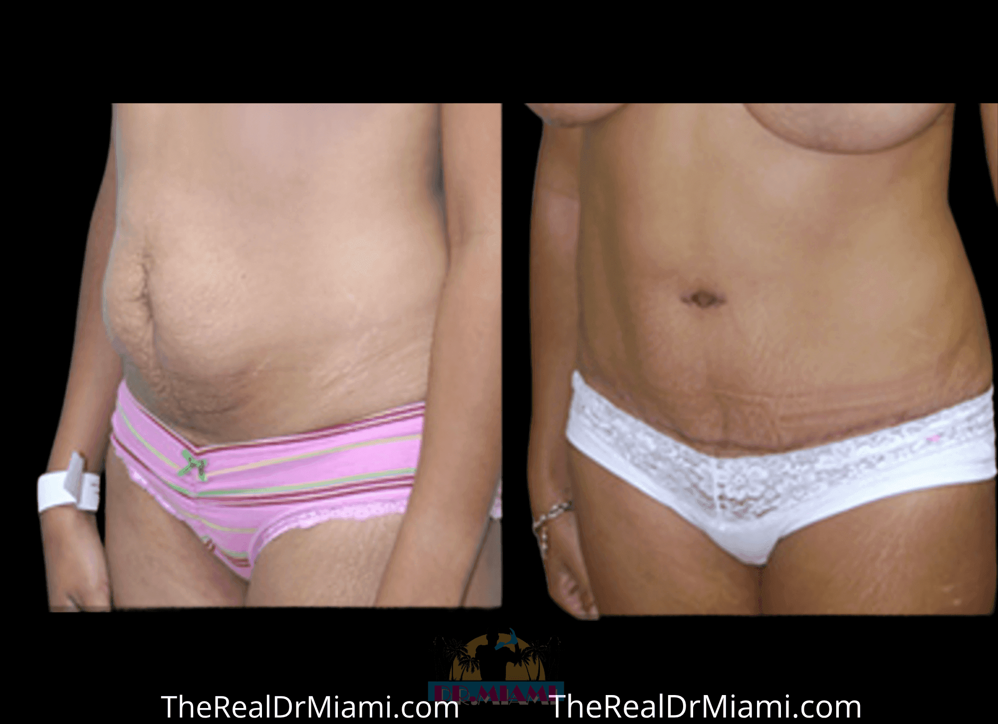 Before-and-after views for Tummy Tuck, Case 86.