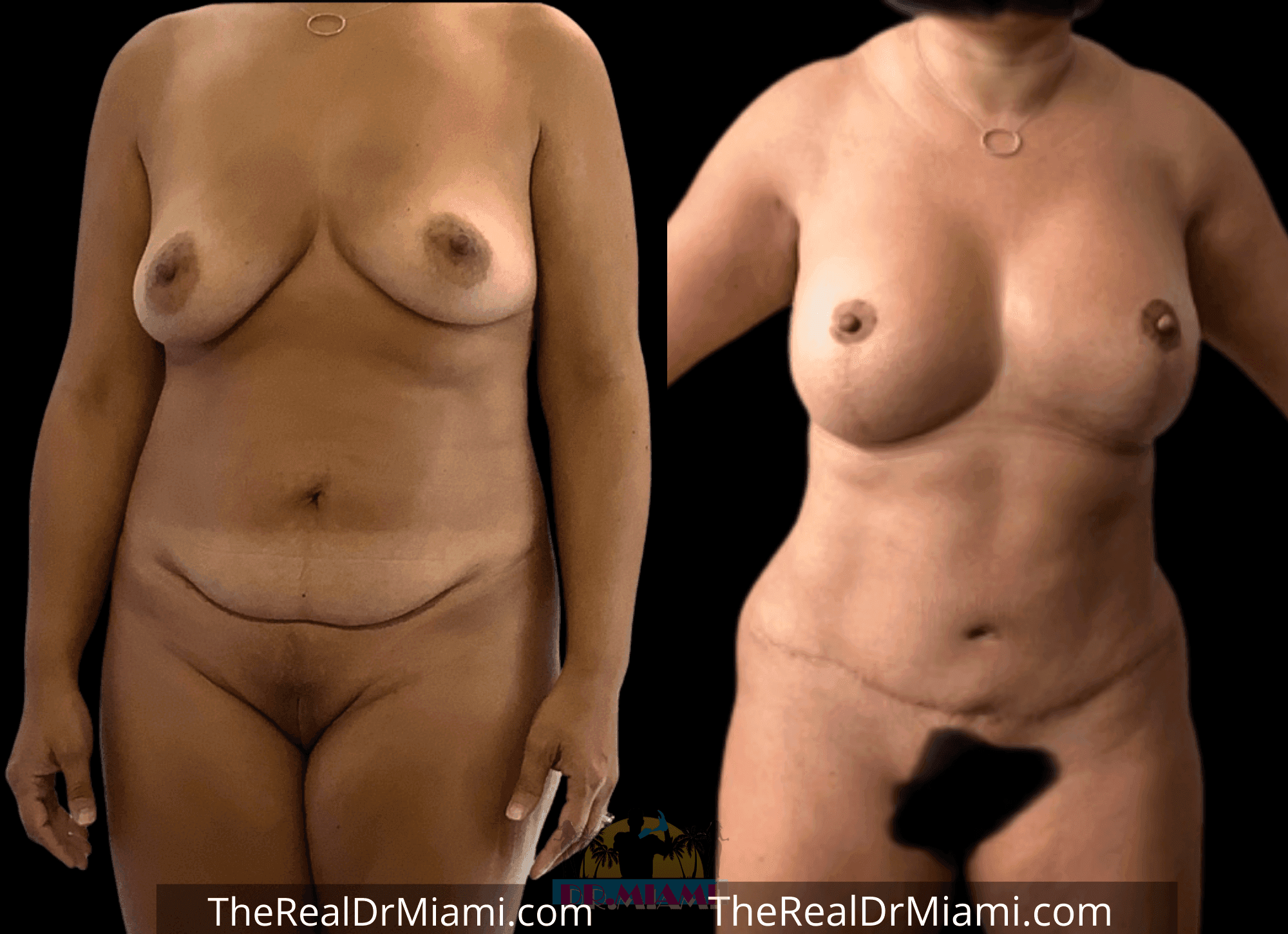 Before-and-after views for Mommy Makeover, Case 67.