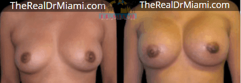 Before-and-after views for Breast Augmentation, Case 103.