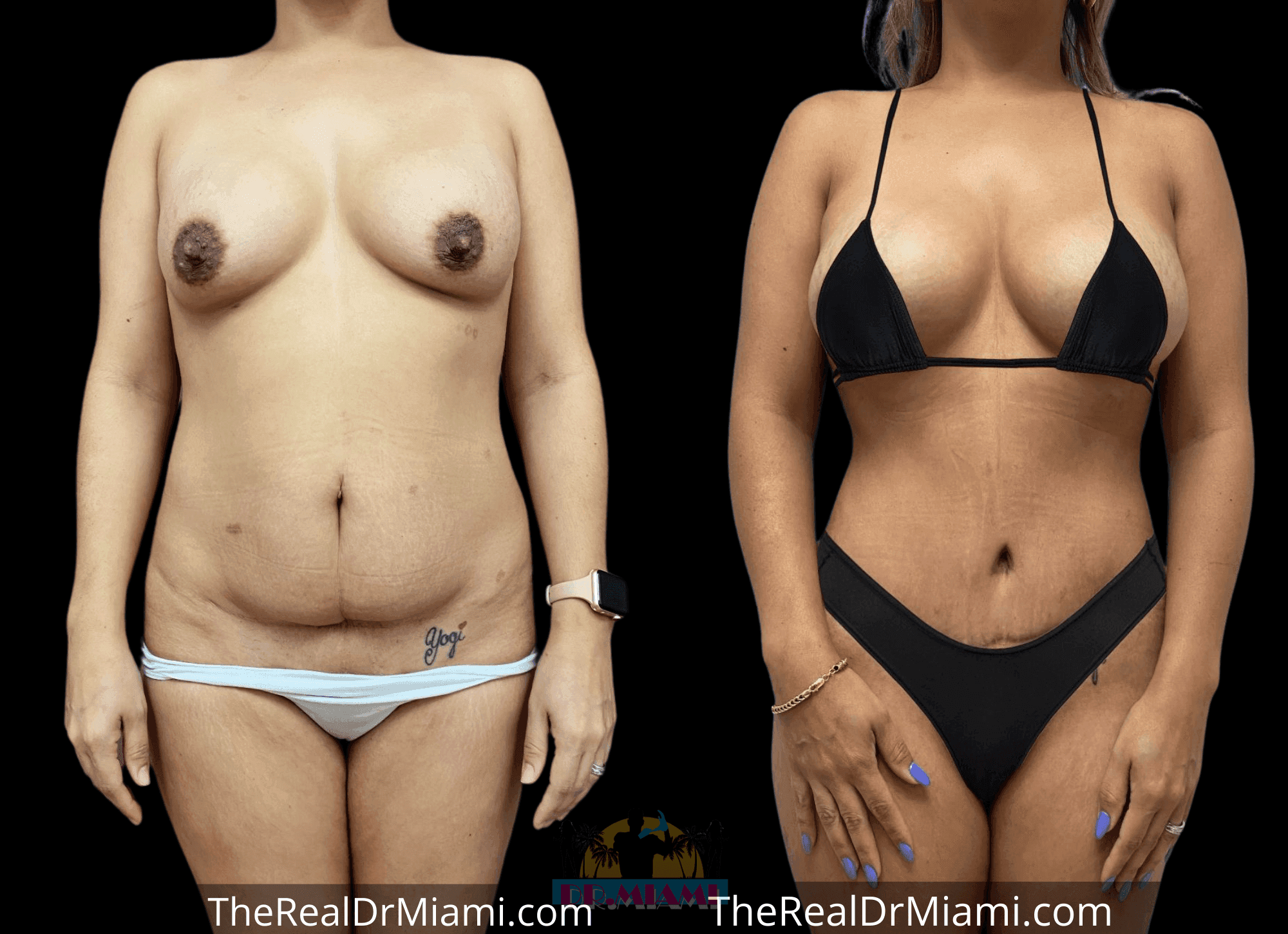 Before-and-after views for Mommy Makeover, Case 82.