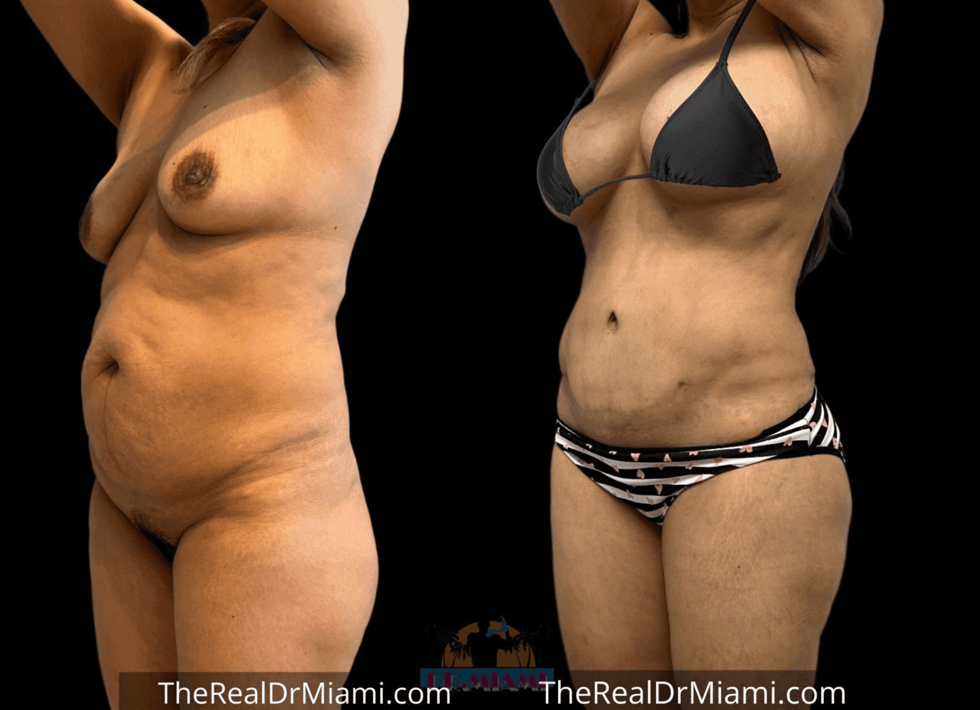 Before-and-after views for Mommy Makeover, Case 27.