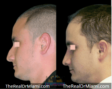 Before-and-after views for Rhinoplasty, Case 84.