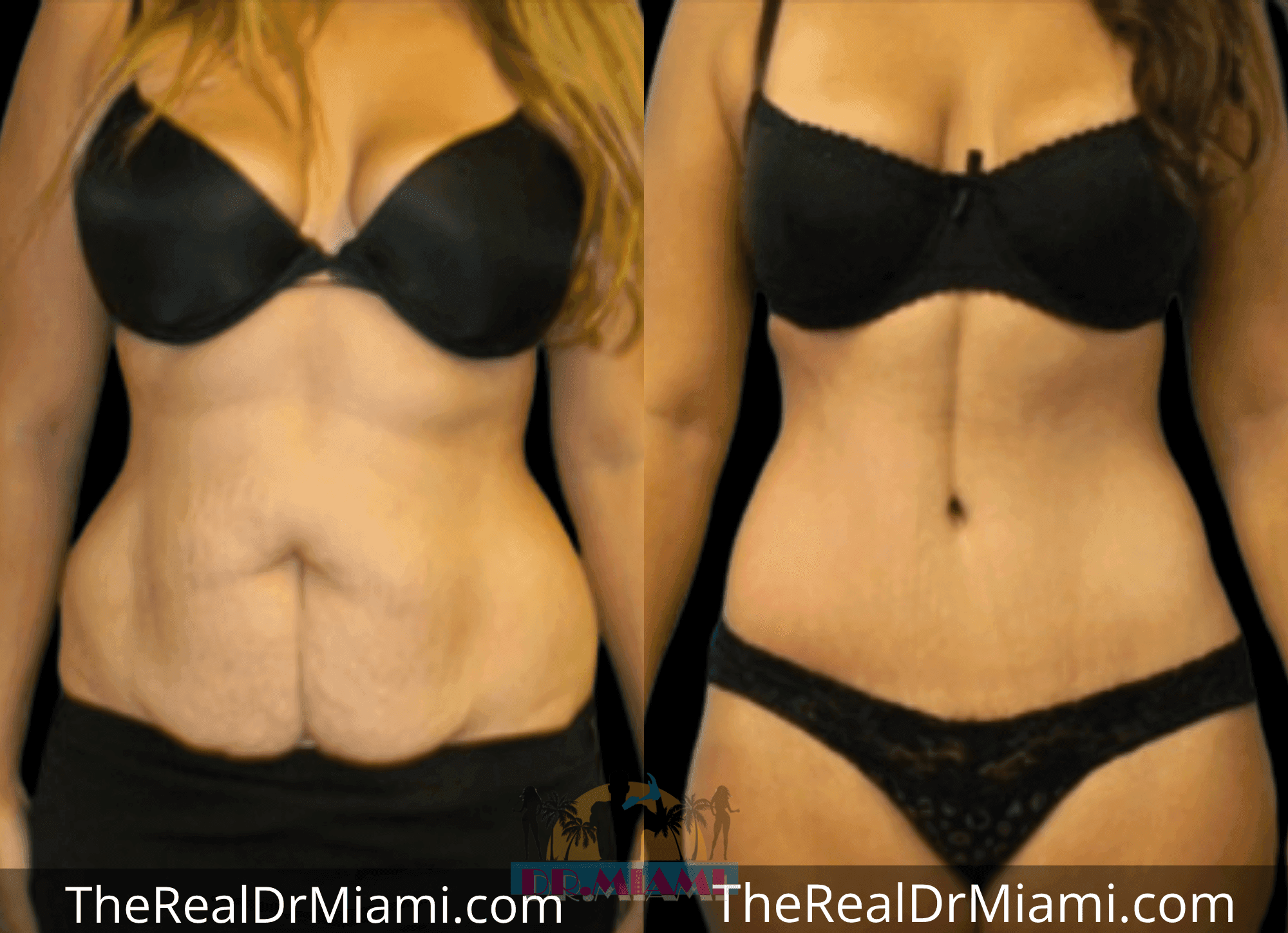 Before-and-after views for Massive Weight Loss, Case 14.