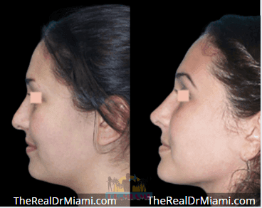 Before-and-after views for Rhinoplasty, Case 83.