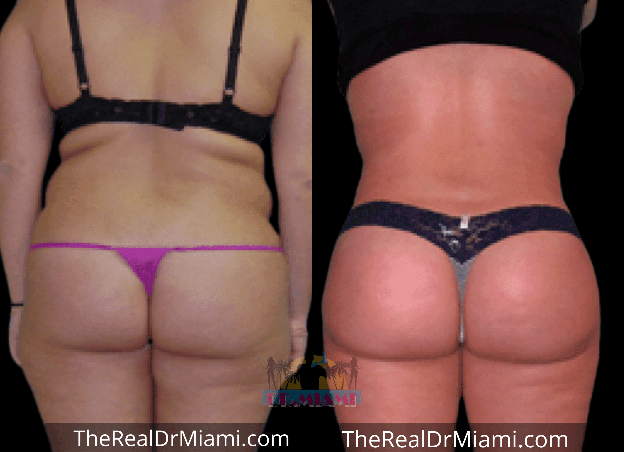 Before-and-after views for Brazilian Butt Lift, Case 97.