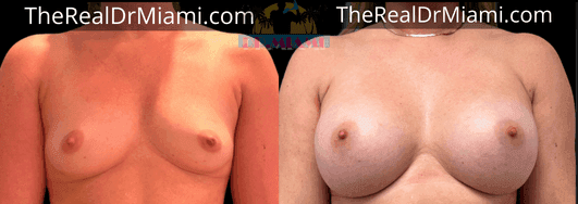 Before-and-after views for Breast Lift, Case 9.