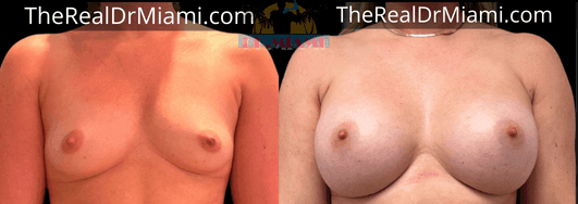 Before-and-after views for Breast Lift, Case 9.