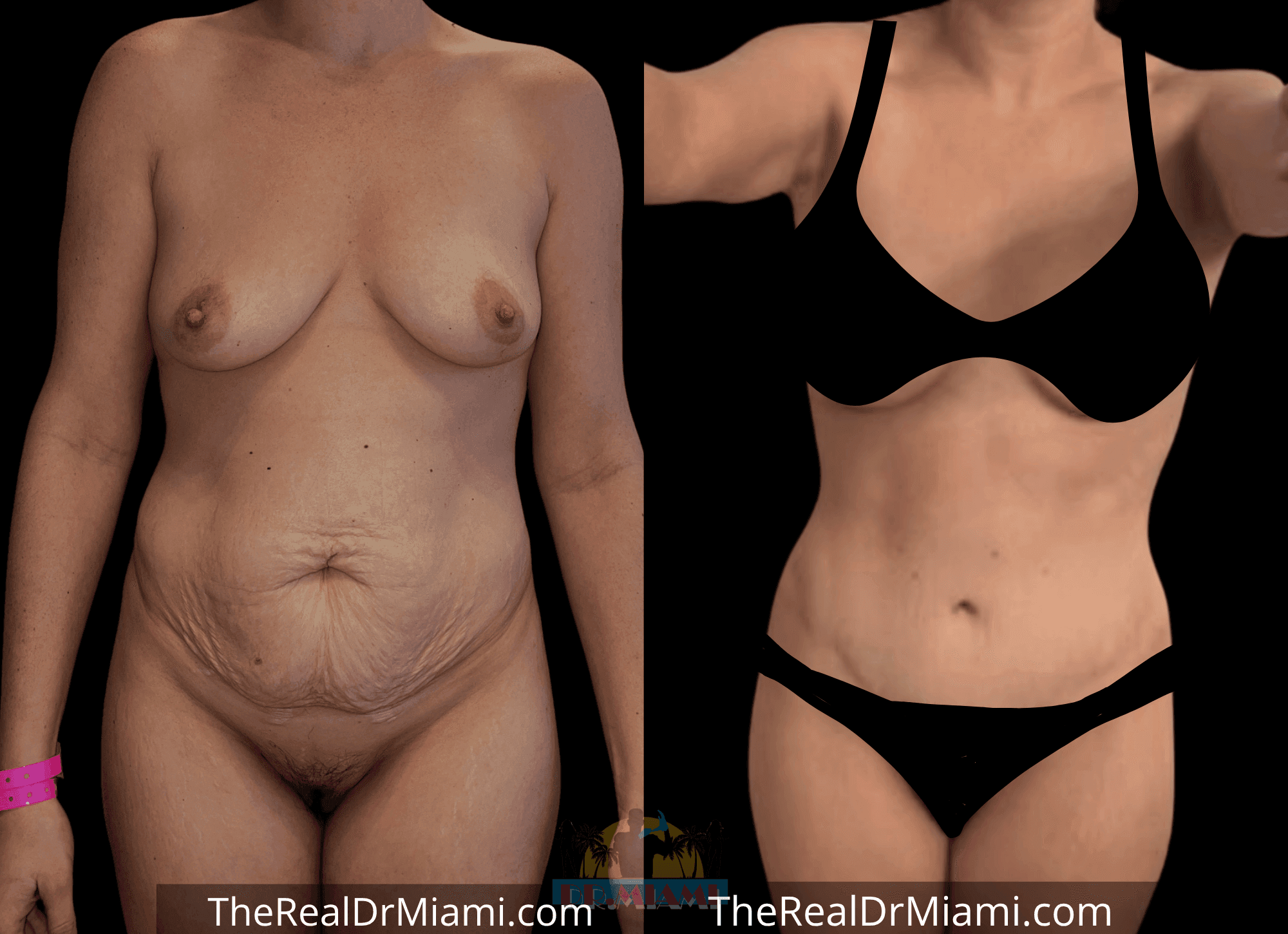 Before-and-after views for Tummy Tuck, Case 107.