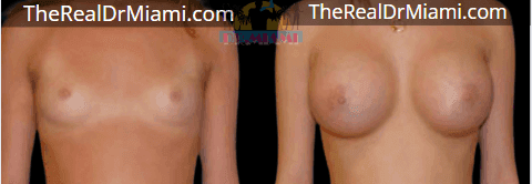 Before-and-after views for Breast Augmentation, Case 124.