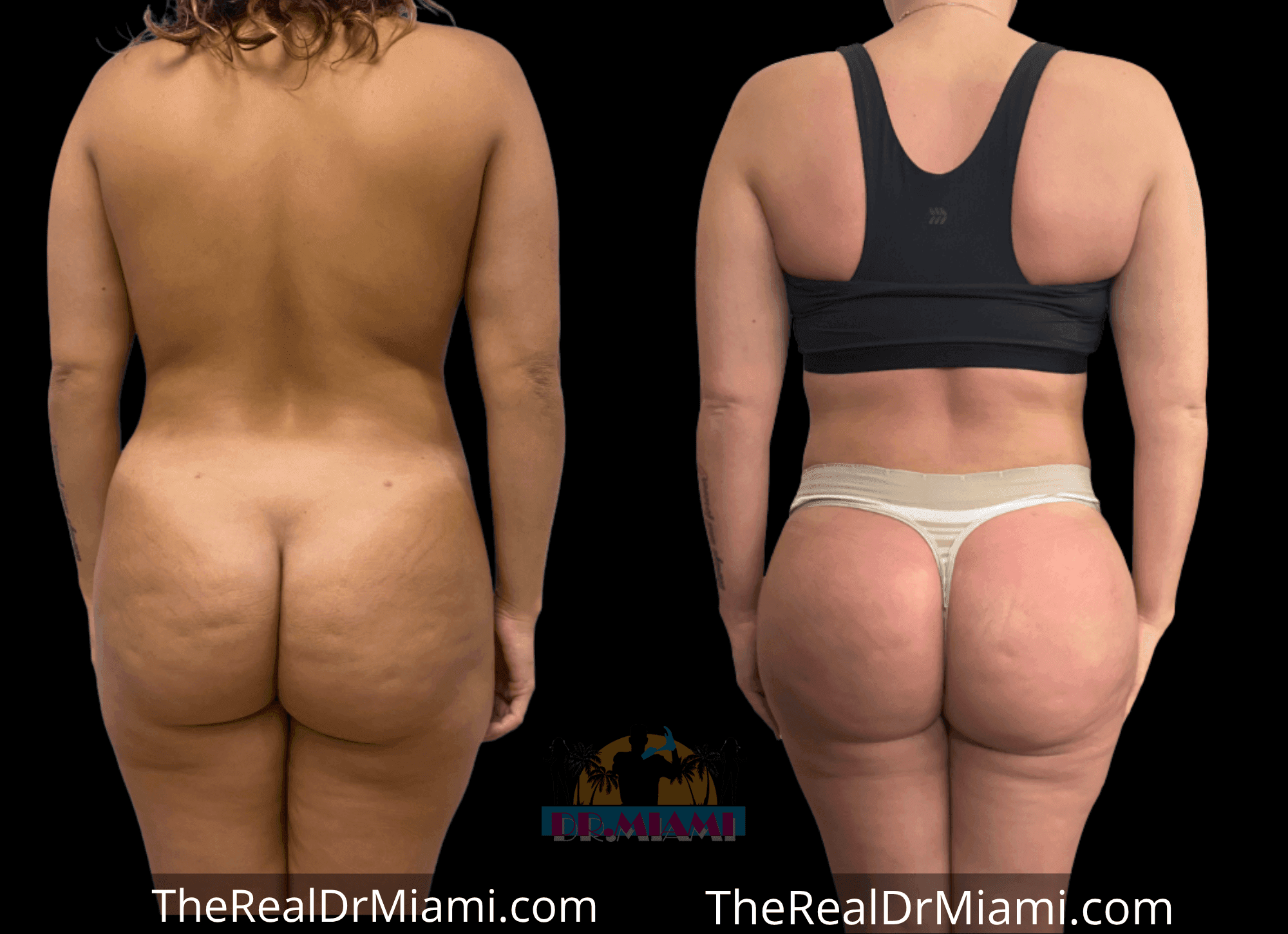 Before-and-after views for Brazilian Butt Lift, Case 115.