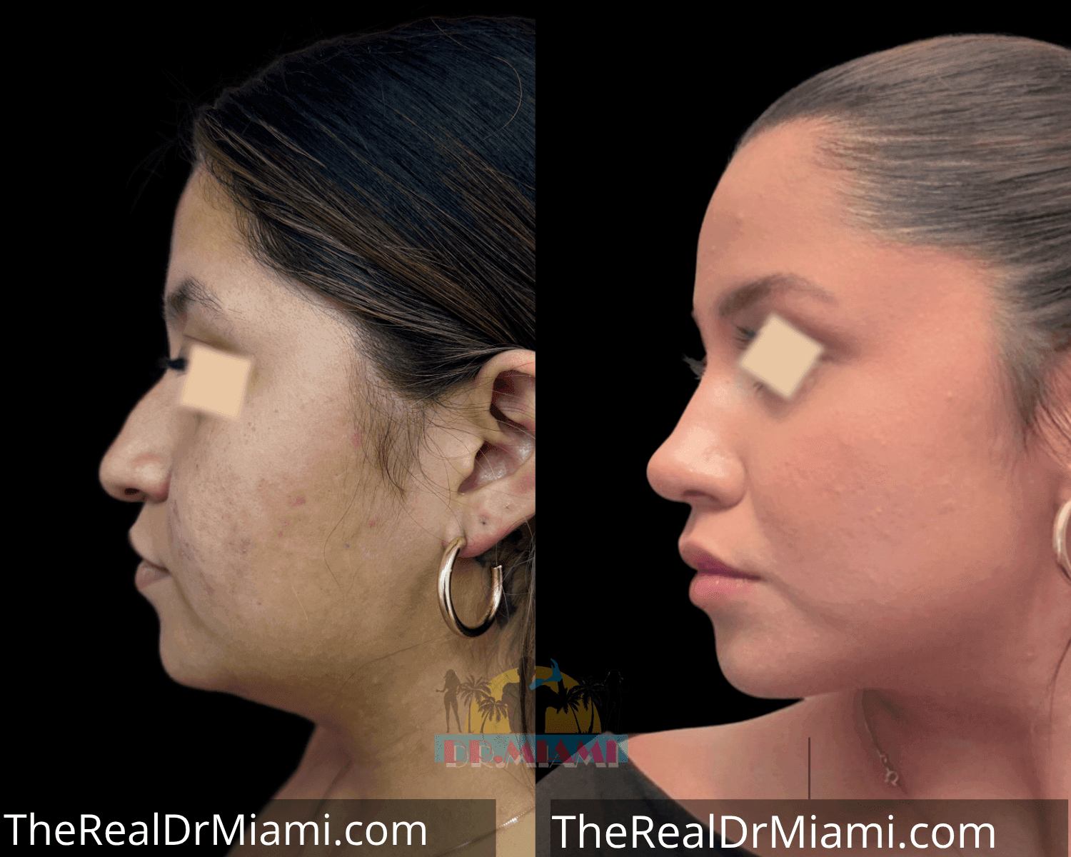 Before-and-after views for Rhinoplasty, Case 8.