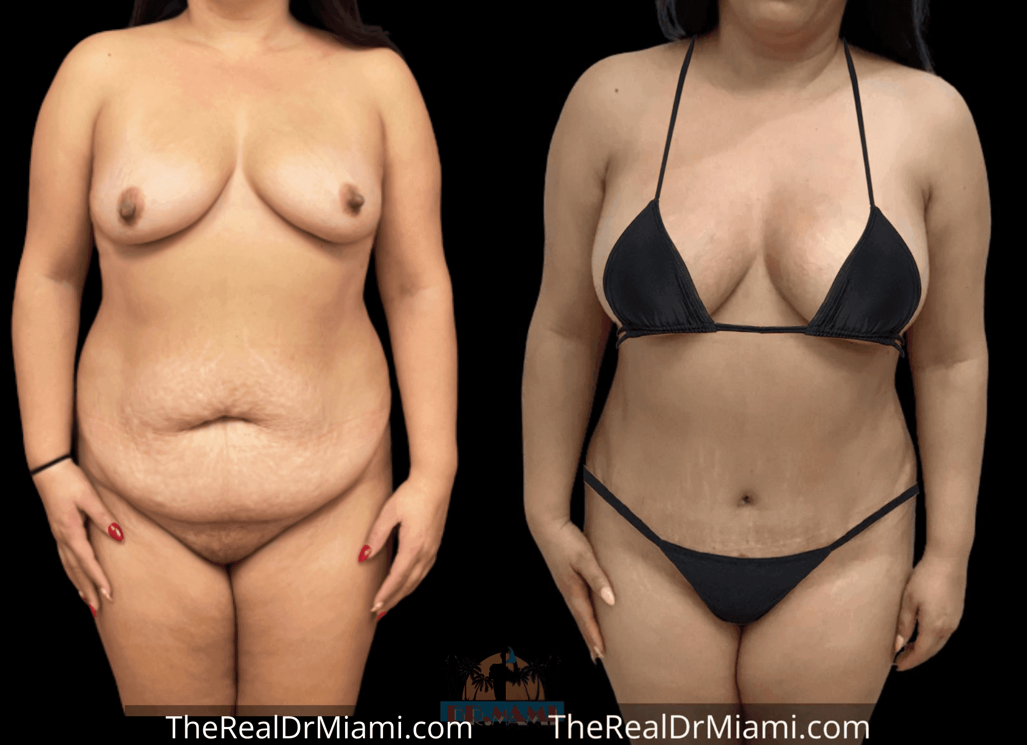 Before-and-after views for Mommy Makeover, Case 90.