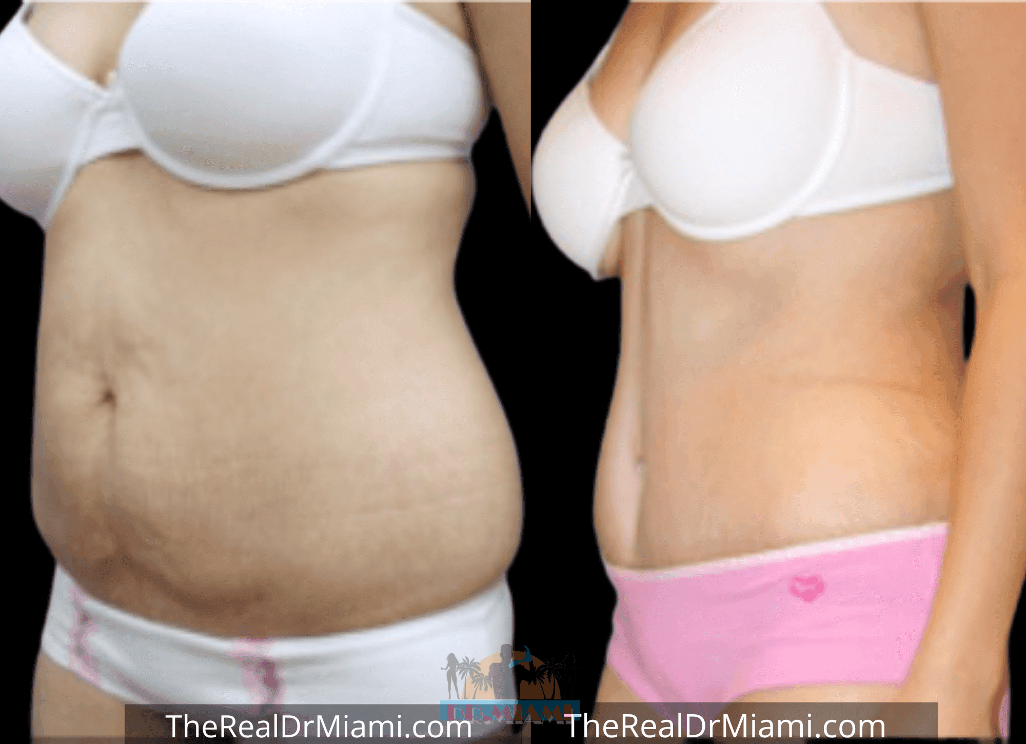 Before-and-after views for Tummy Tuck, Case 83.