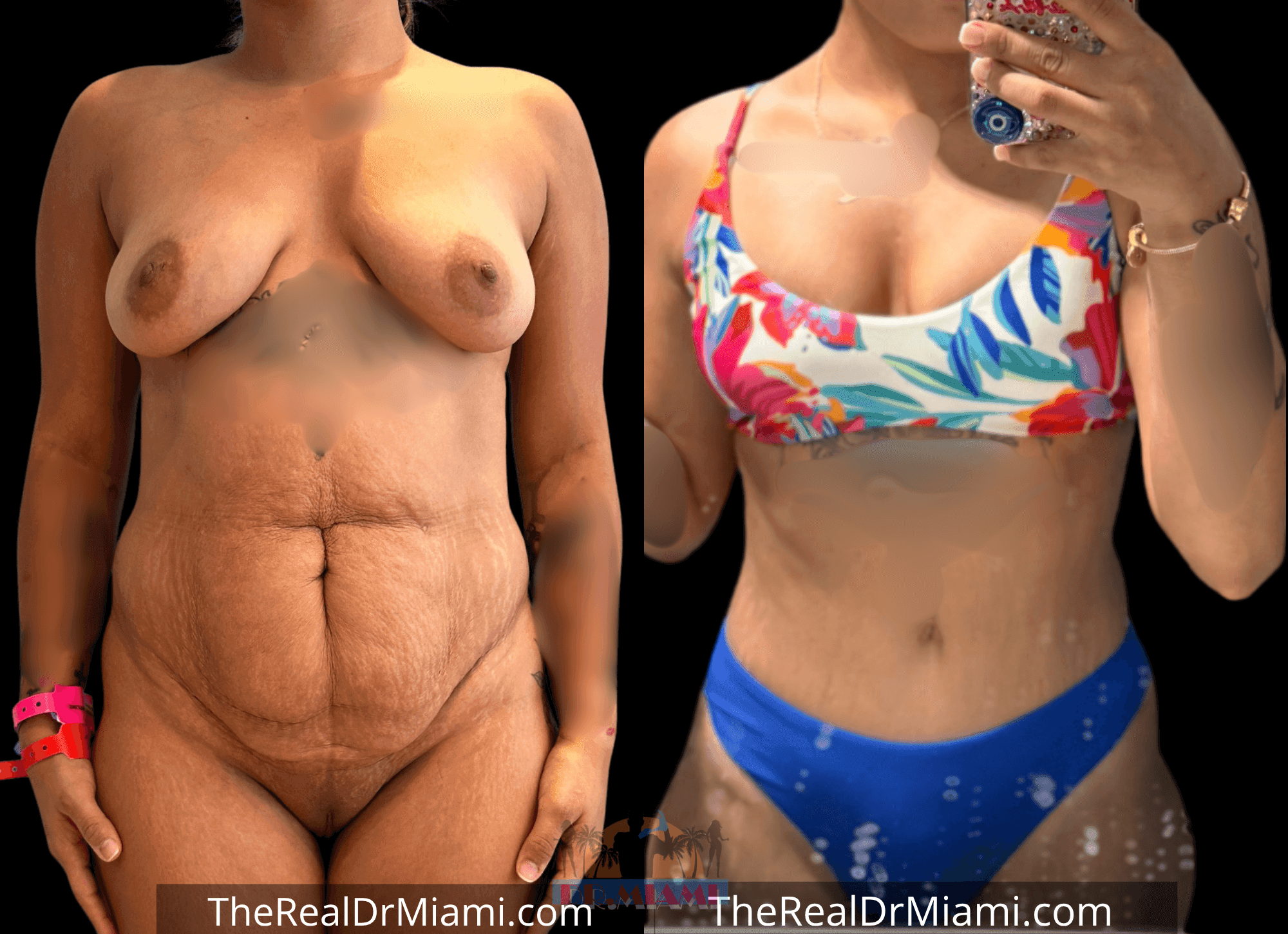 Before-and-after views for Mommy Makeover, Case 104.