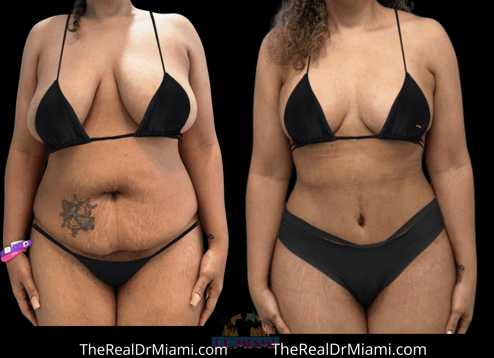 Before-and-after views for Mommy Makeover, Case 124.