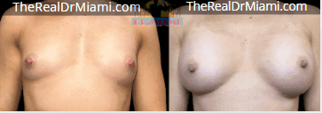 Before-and-after views for Breast Augmentation, Case 49.