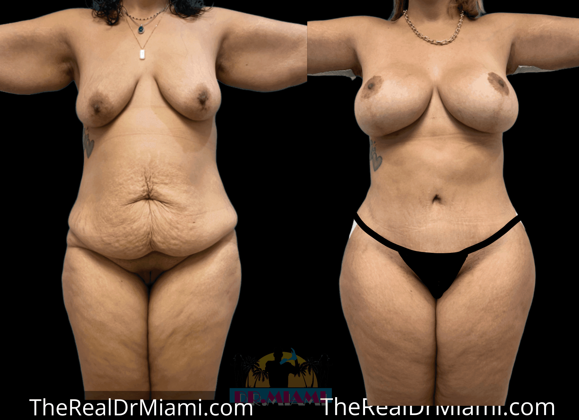 Before-and-after views for Massive Weight Loss, Case 33.