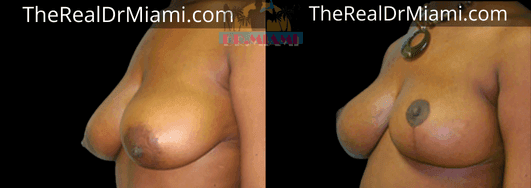 Before-and-after views for Breast Lift, Case 40.