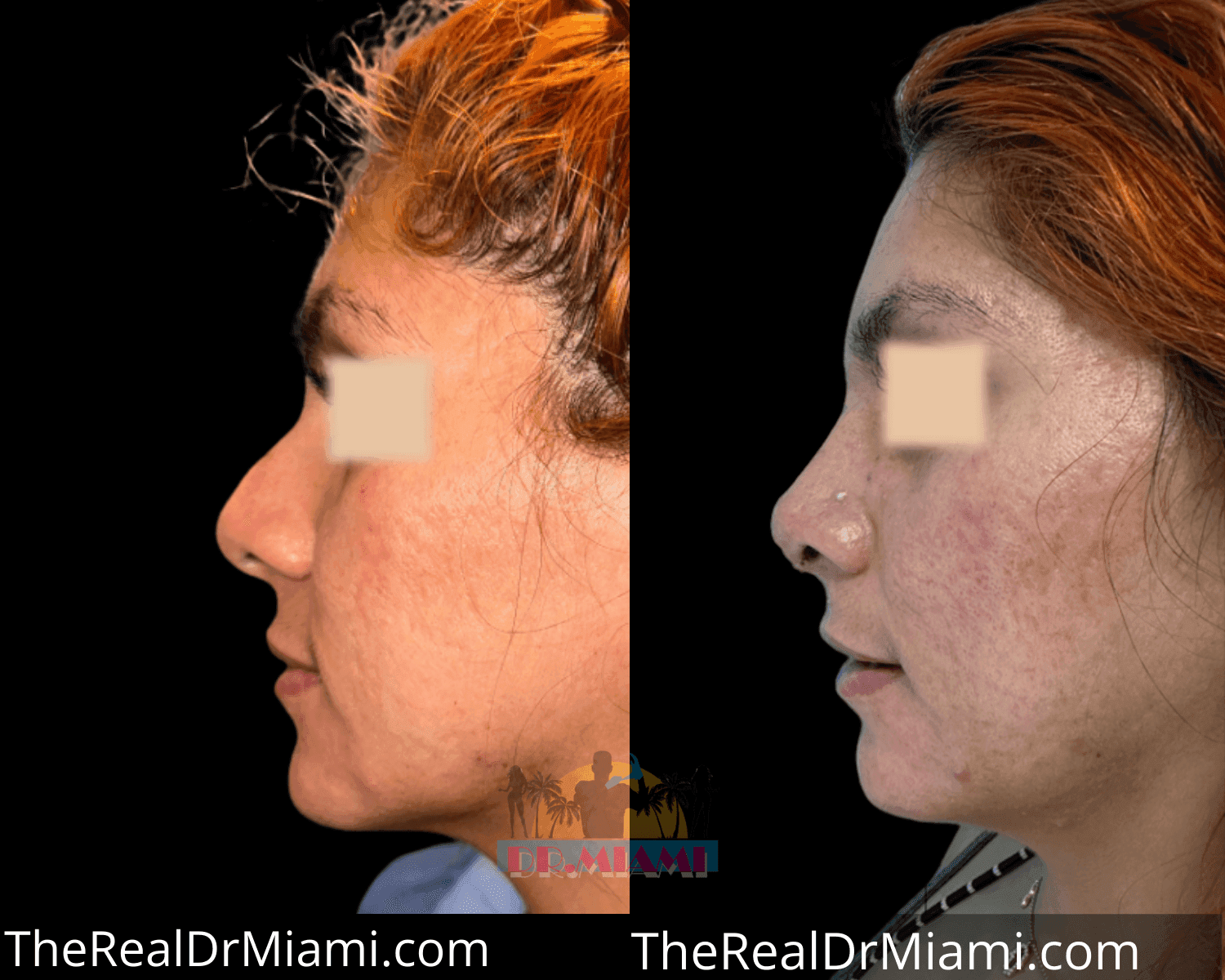 Before-and-after views for Rhinoplasty, Case 39.