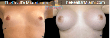 Before-and-after views for Breast Augmentation, Case 62.