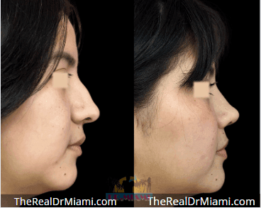 Before-and-after views for Rhinoplasty, Case 126.