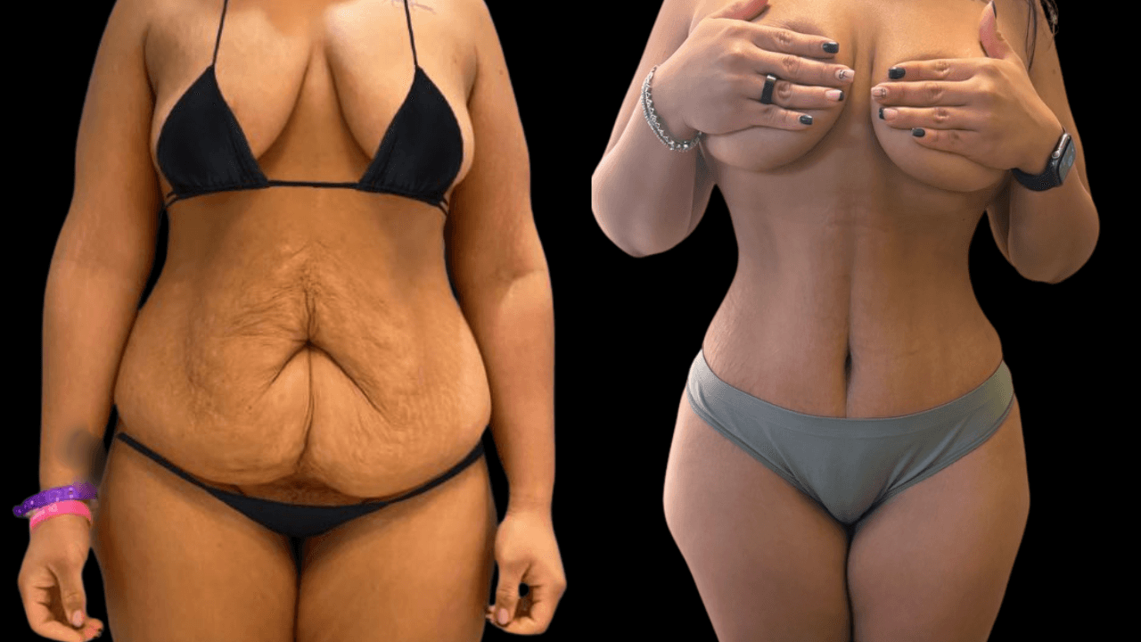 Before-and-after views for Tummy Tuck, Case 1 from The Next Dr. Miami collection.