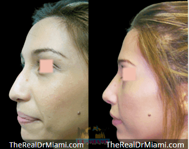Before-and-after views for Rhinoplasty, Case 79.