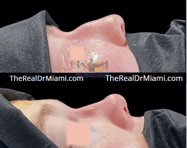 Before-and-after views for Rhinoplasty, Case 110.