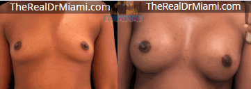 Before-and-after views for Breast Augmentation, Case 57.