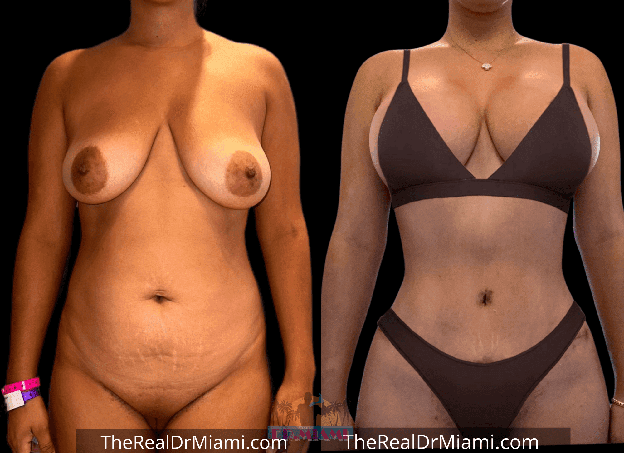 Before-and-after views for Mommy Makeover, Case 100.