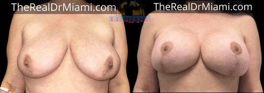 Before-and-after views for Breast Lift, Case 71.