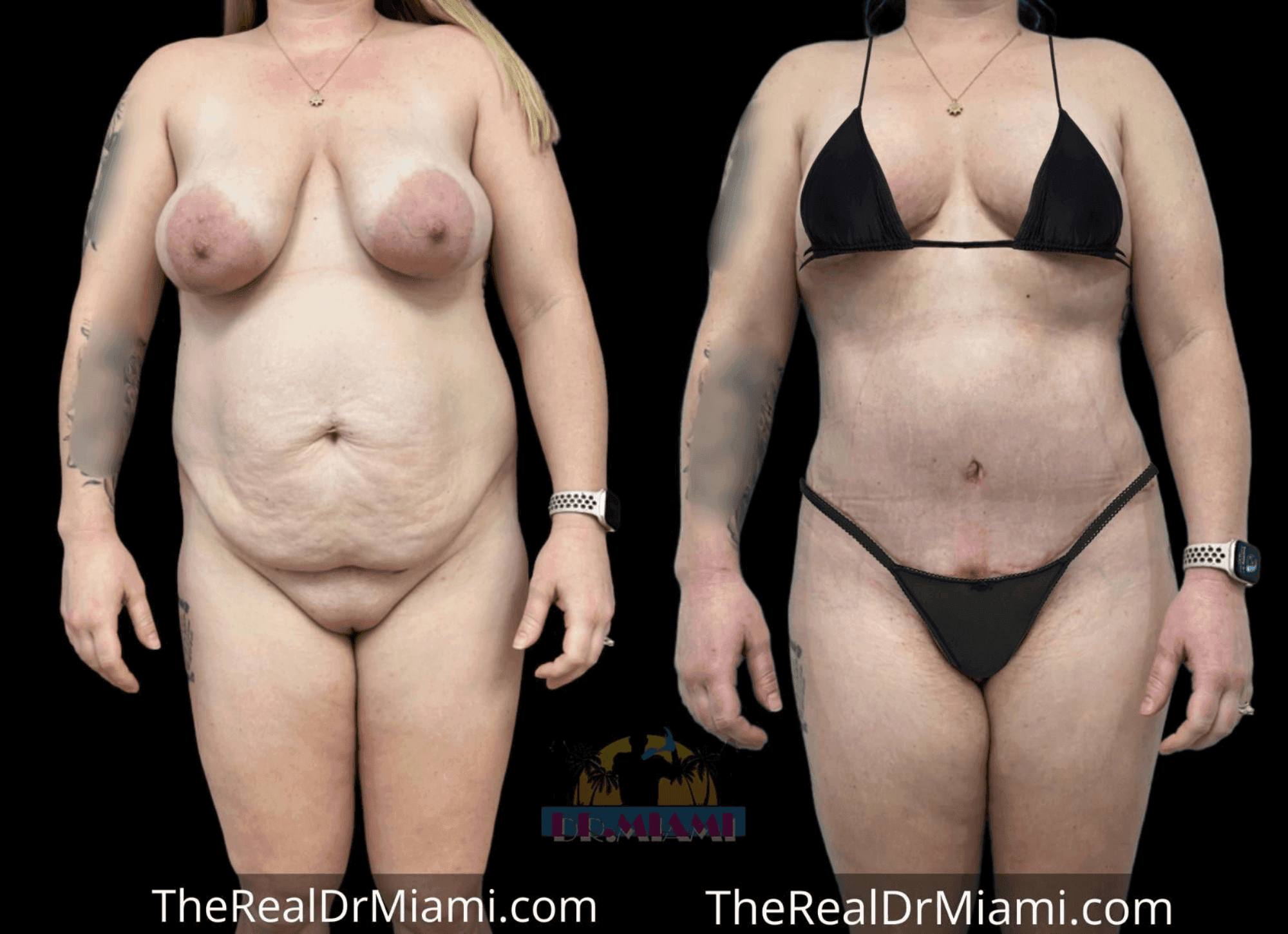 Before-and-after views for Mommy Makeover, Case 71.