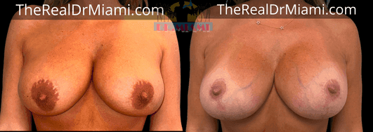Before-and-after views for Breast Lift, Case 2.