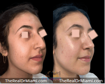 Before-and-after views for Rhinoplasty, Case 116.