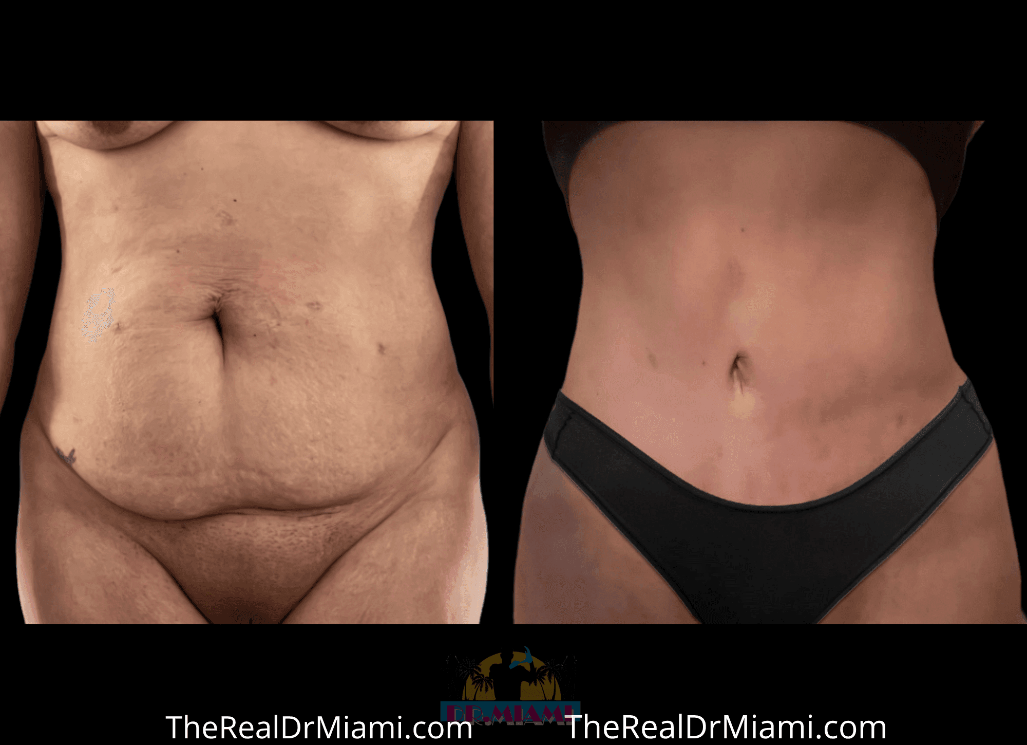 Before-and-after views for Tummy Tuck, Case 38.