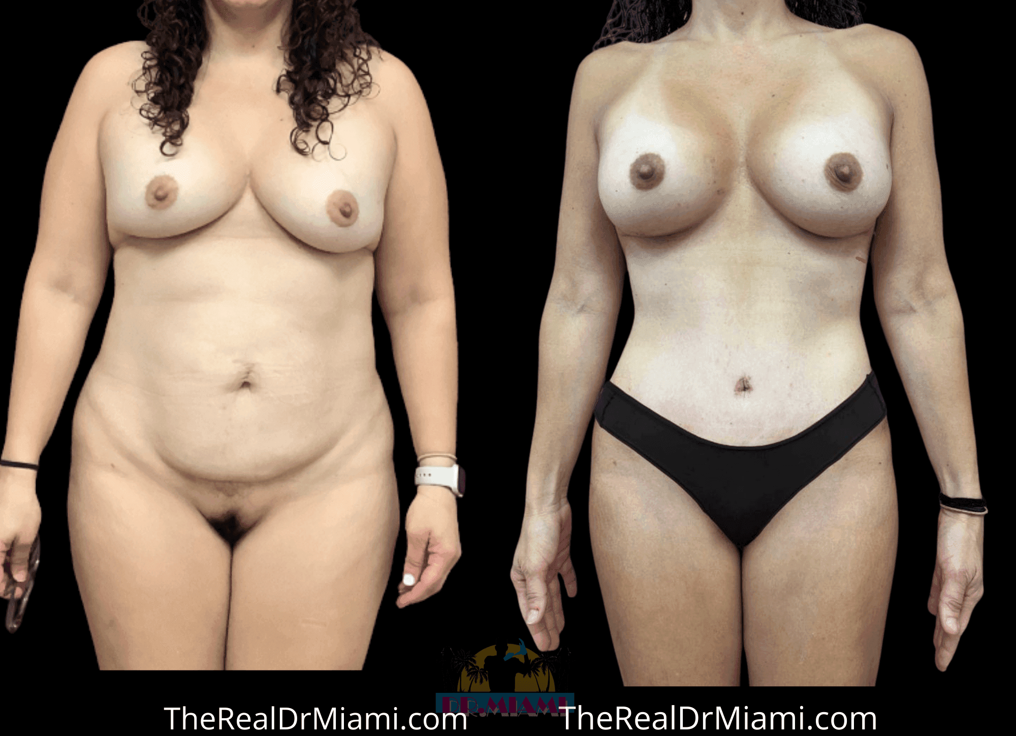 Before-and-after views for Mommy Makeover, Case 123.