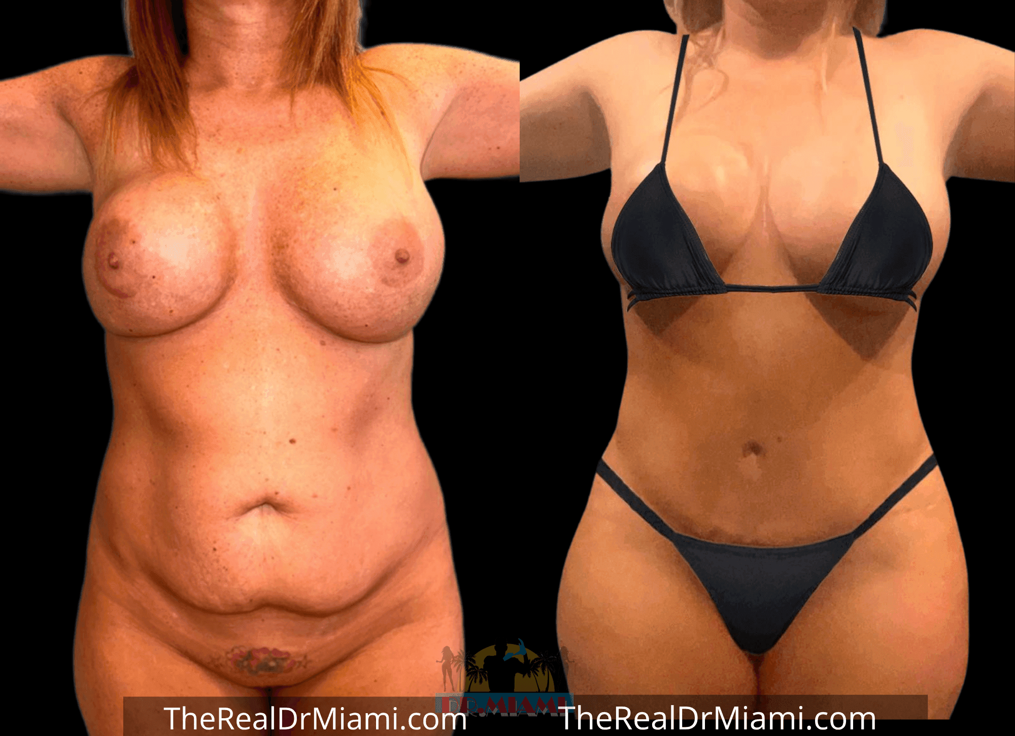 Before-and-after views for Tummy Tuck, Case 46.
