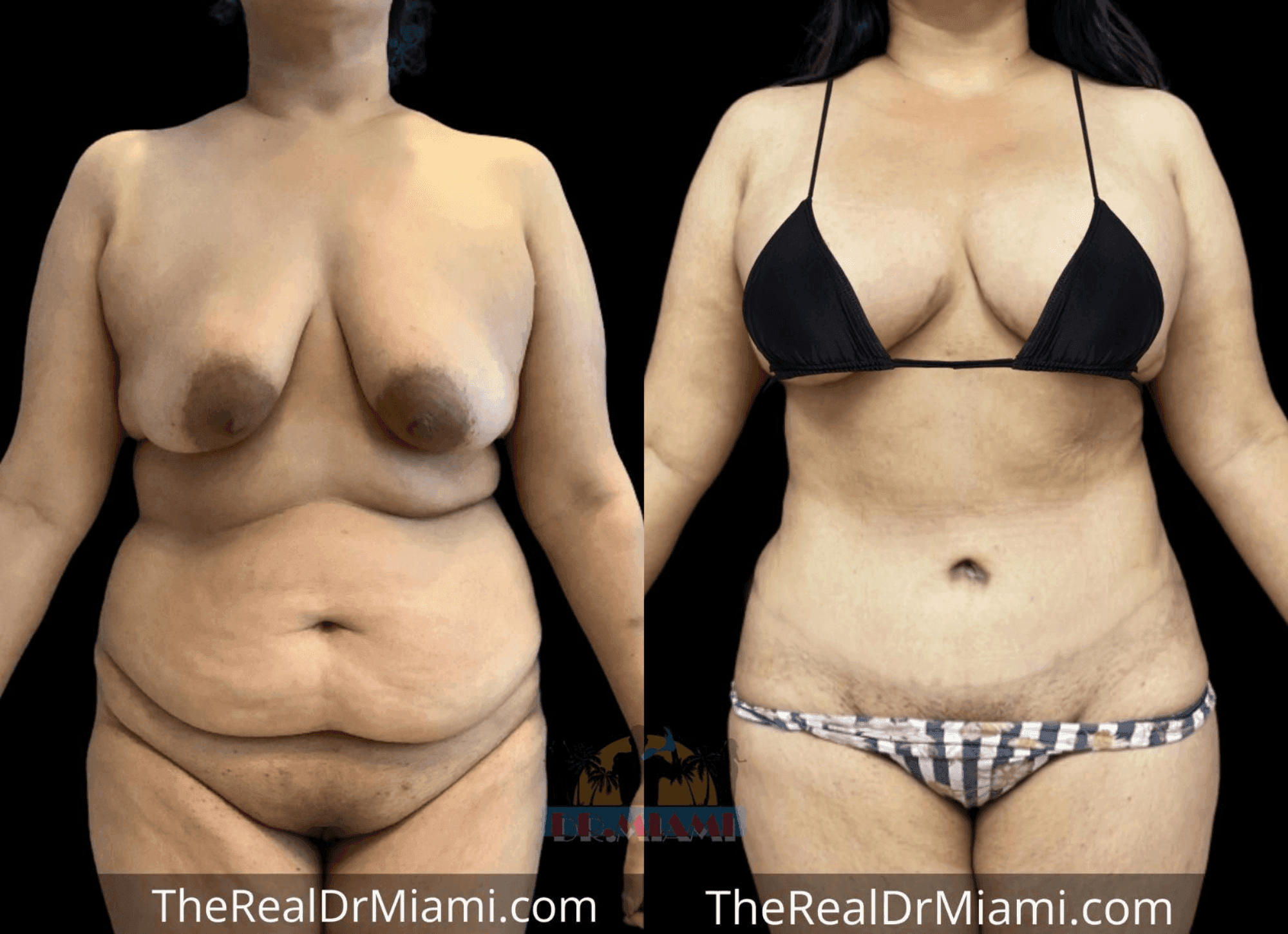 Before-and-after views for Mommy Makeover, Case 62.