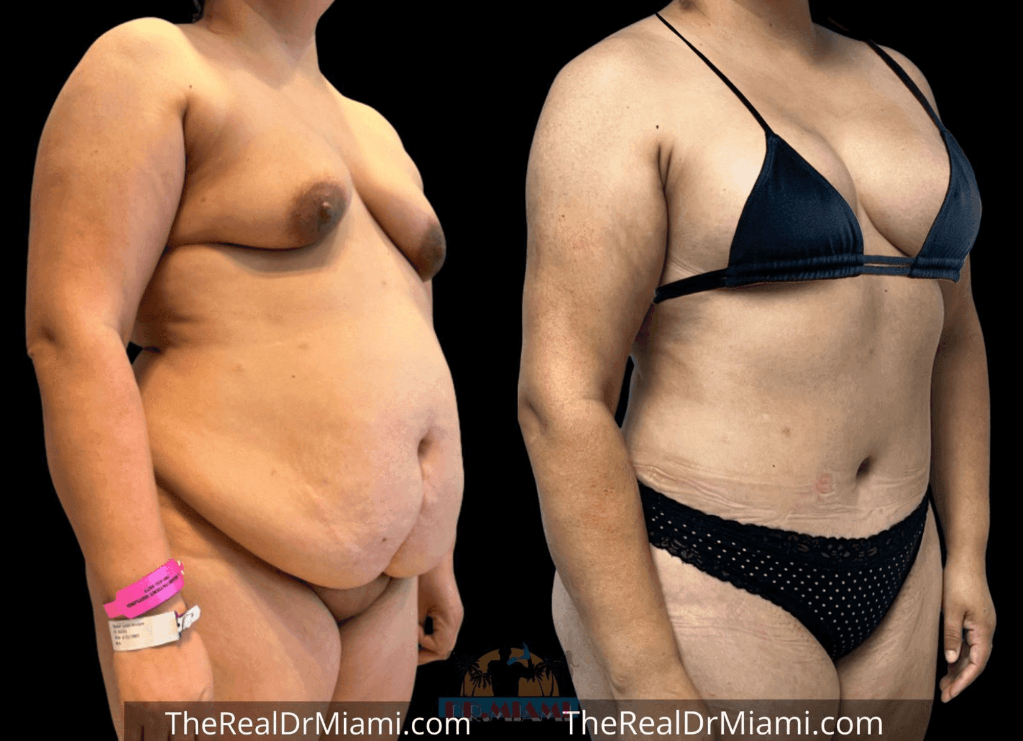 Before-and-after views for Tummy Tuck, Case 39.
