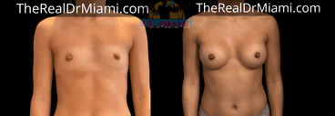 Before-and-after views for Breast Augmentation, Case 78.