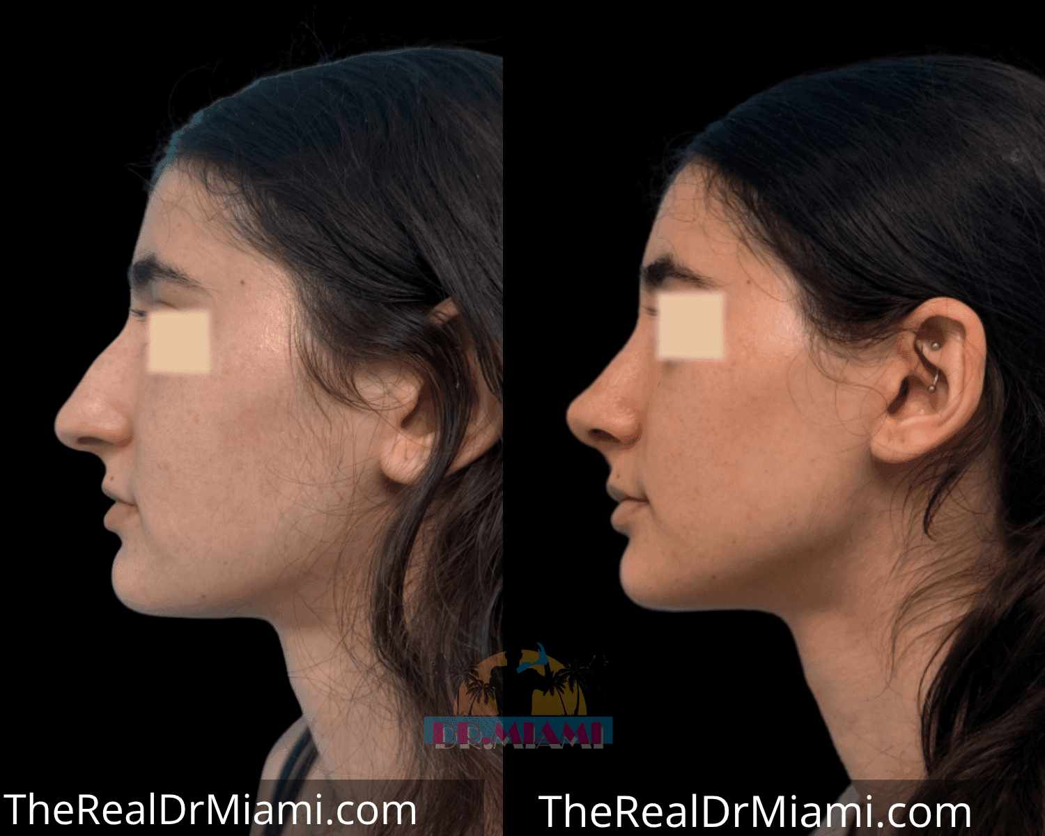 Before-and-after views for Rhinoplasty, Case 12.