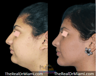Before-and-after views for Rhinoplasty, Case 60.
