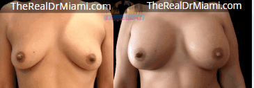 Before-and-after views for Breast Augmentation, Case 53.