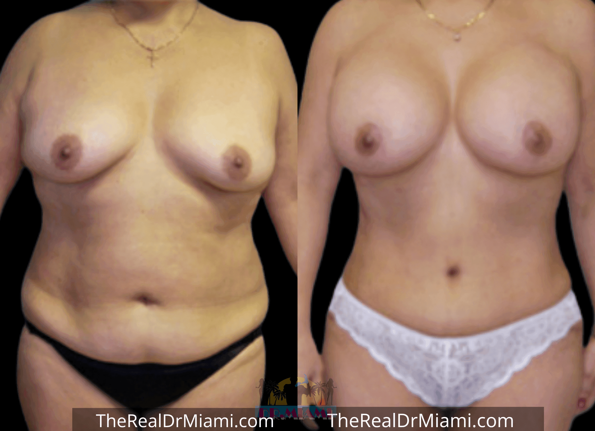 Before-and-after views for Mommy Makeover, Case 93.