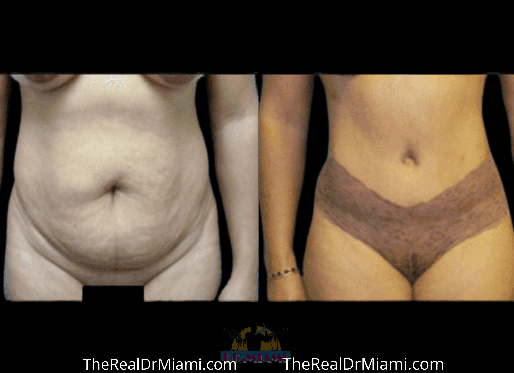 Before-and-after views for Tummy Tuck, Case 85.