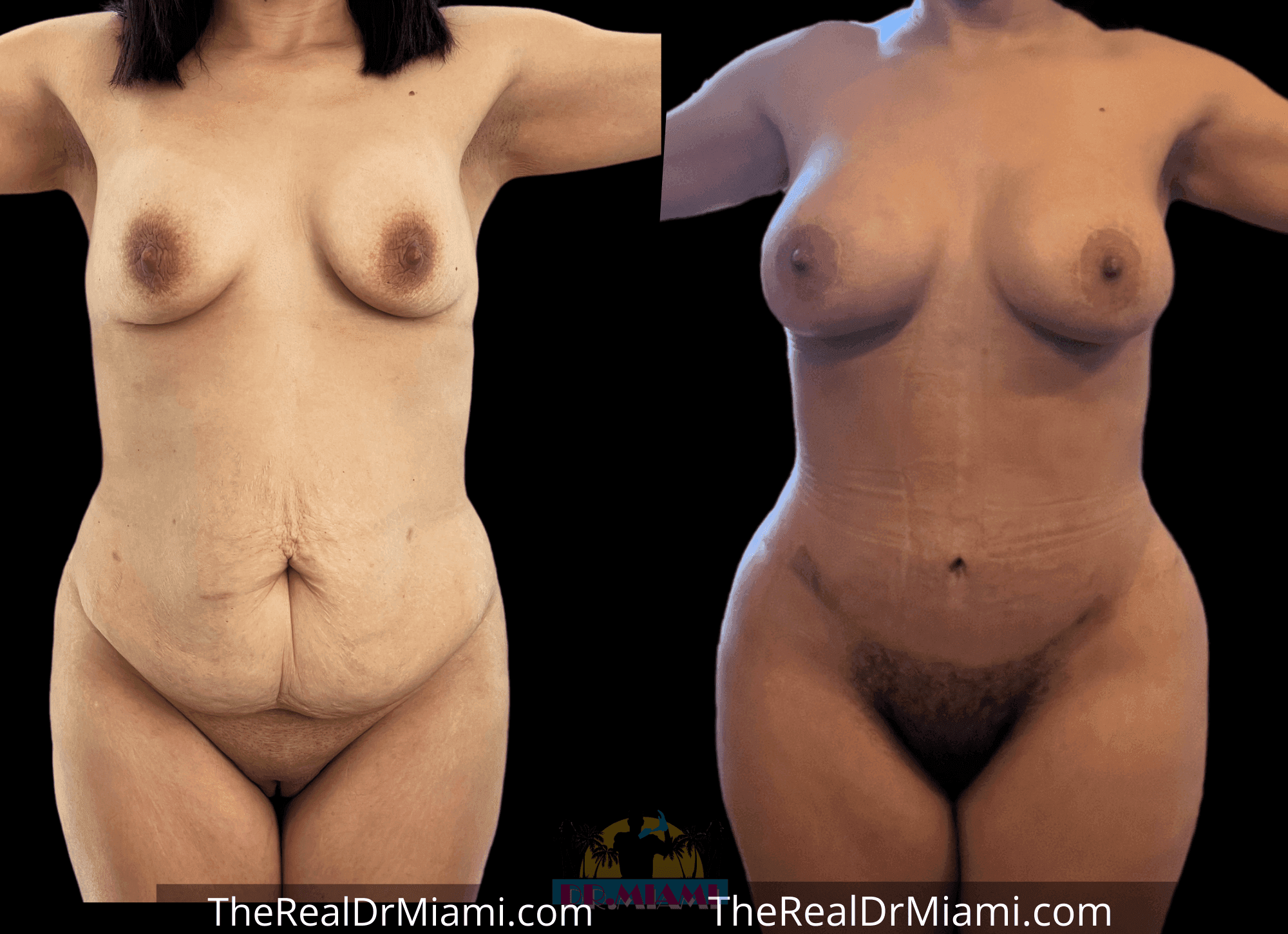 Before-and-after views for Mommy Makeover, Case 10.