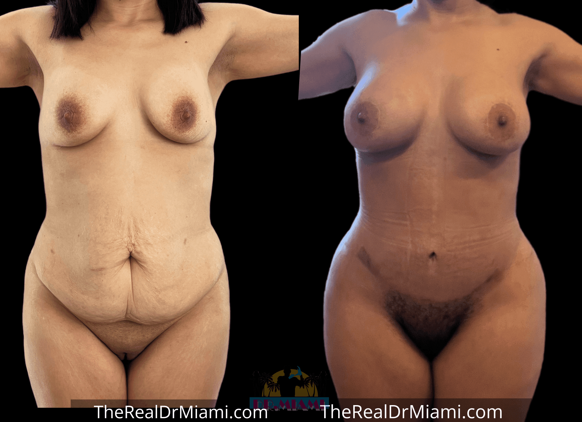 Before-and-after views for Mommy Makeover, Case 10.