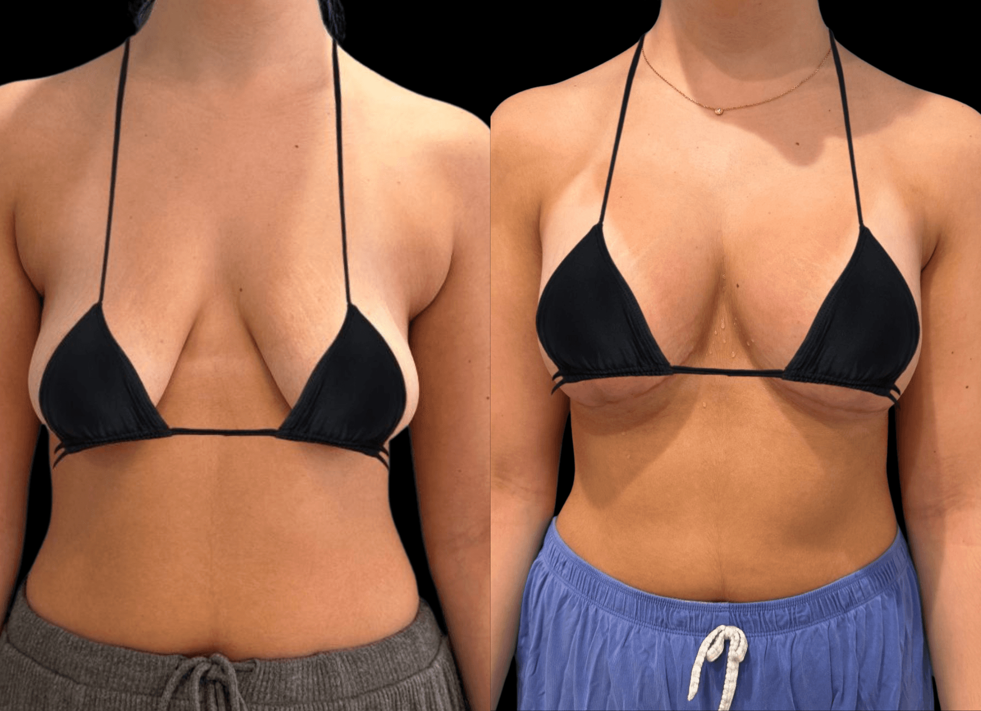 Before-and-after views for Breast Augmentation / Lift, Case 16 from The Next Dr. Miami collection.