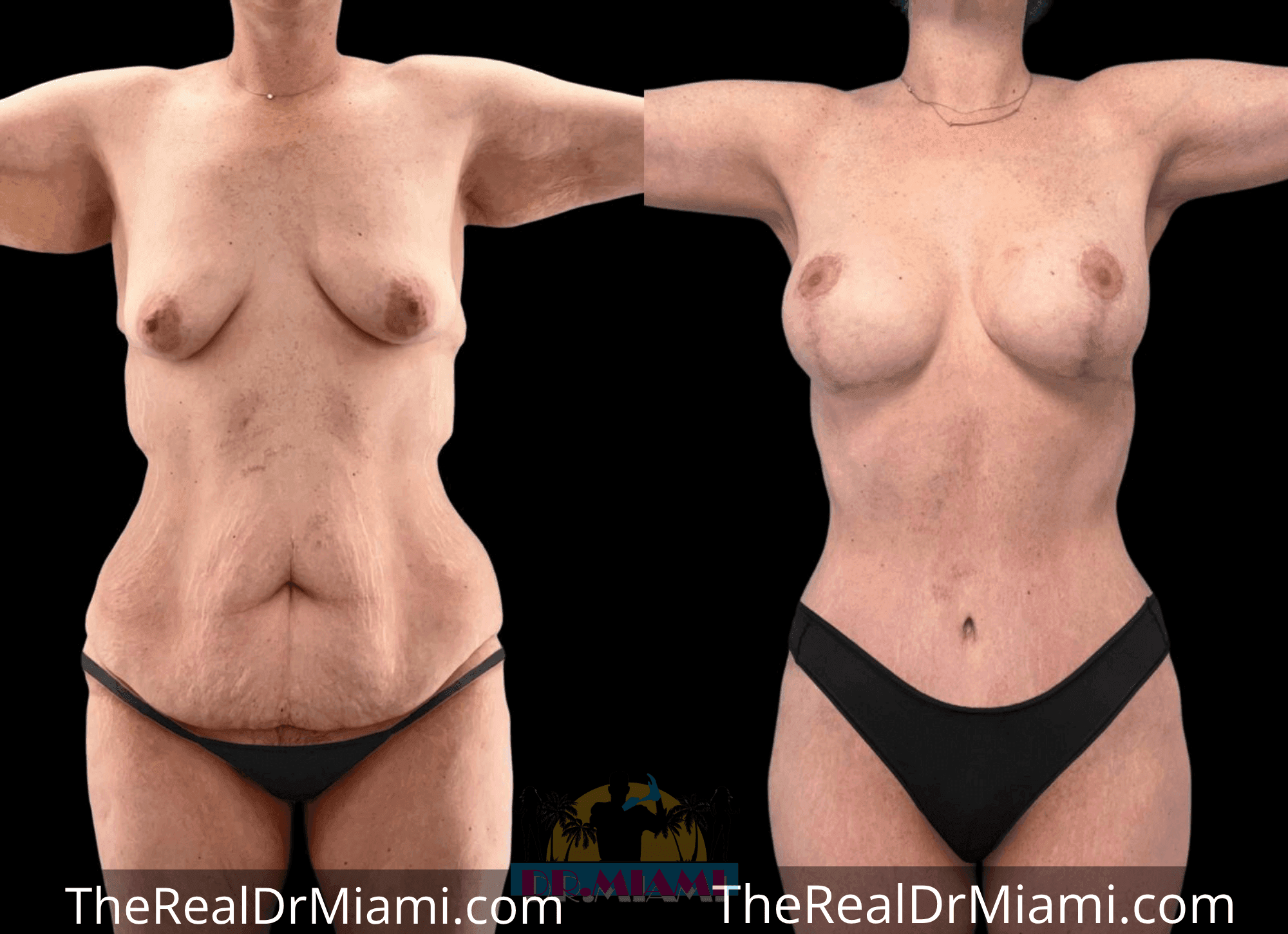 Before-and-after views for Massive Weight Loss, Case 4.