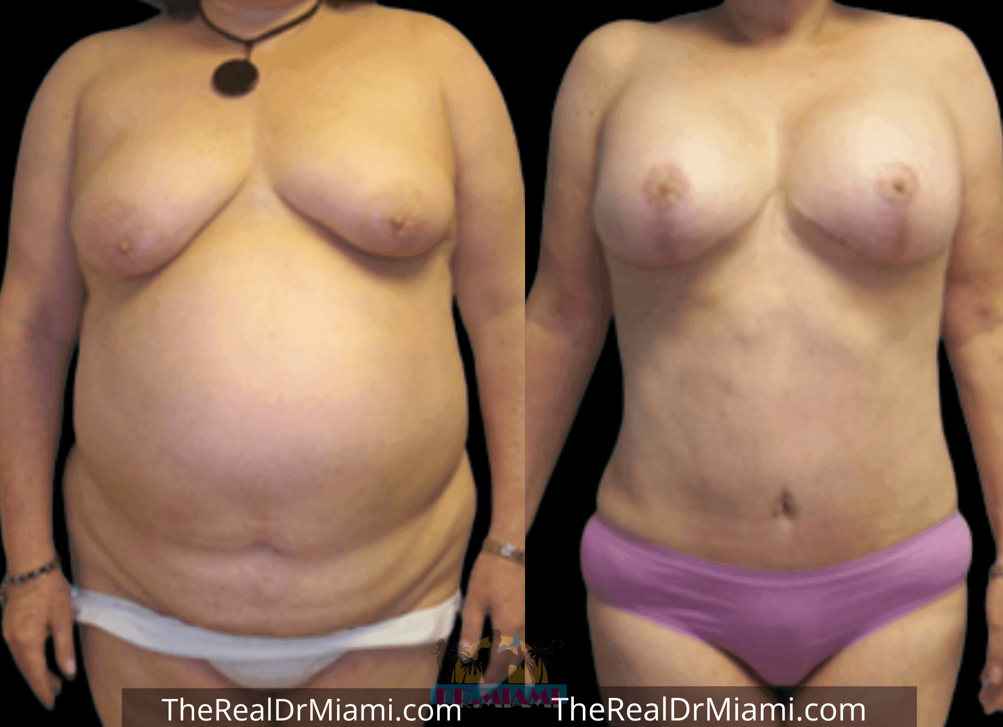 Before-and-after views for Tummy Tuck, Case 62.